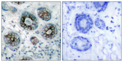 Immunohistochemistry analysis of paraffin-embedded human breast carcinoma tissue, using GAP43 Antibody. The picture on the right is blocked with the synthesized peptide.