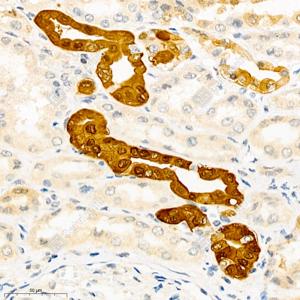 IHC analysis of Calbindin.Sample: Human renal cancer, 4% PFA 12-24h.Antigen retrieval: Citrate buffer , 98℃, 20 min.Primary antibody: 1: 1000, 4℃ overnight.Secondary antibody: HRP conjugated Goat Anti-Rabbit lgG , 1: 200, RT, 1h.