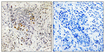 Immunohistochemical analysis of paraffin-embedded Human lung cancer. Antibody was diluted at 1:100(4° overnight). High-pressure and temperature Tris-EDTA,pH8.0 was used for antigen retrieval. Negetive contrl (right) obtaned from antibody was pre-absorbe
