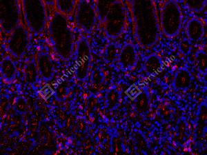 IF analysis ofbeta Actinred.Sample: Human colon cancer, 4% PFA 12-24h.Antigen retrieval: Tris-EDTA buffer , 98℃, 20min.Blocking buffer: 3% BSA in PBS, RT, 30min.Primary antibody: 1: 1000, 4℃ overnight.Secondary antibody: Cy3 conjugated Goat Anti-Rabbit IgG , 1: 300, RT, 1h.