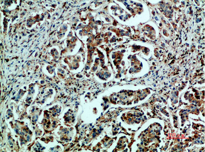 Immunohistochemical analysis of paraffin-embedded human-breast-cancer, antibody was diluted at 1:200