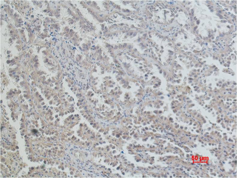 Immunohistochemical analysis of paraffin-embedded Human Lung Caricnoma using  ERCC1 Mouse mAb diluted at 1:200.