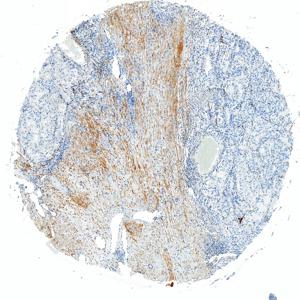 IHC analysis of Vinculin.Sample: Human Renal cancer, 4% PFA 12-24h.Antigen retrieval: Citrate buffer , pressure cooker 2 min.Primary antibody: 1: 1000, 4℃ overnight.Secondary antibody: S-vision poly-HRP conjugated Goat Anti-Mouse lgG , Ready to use, RT, 20min.