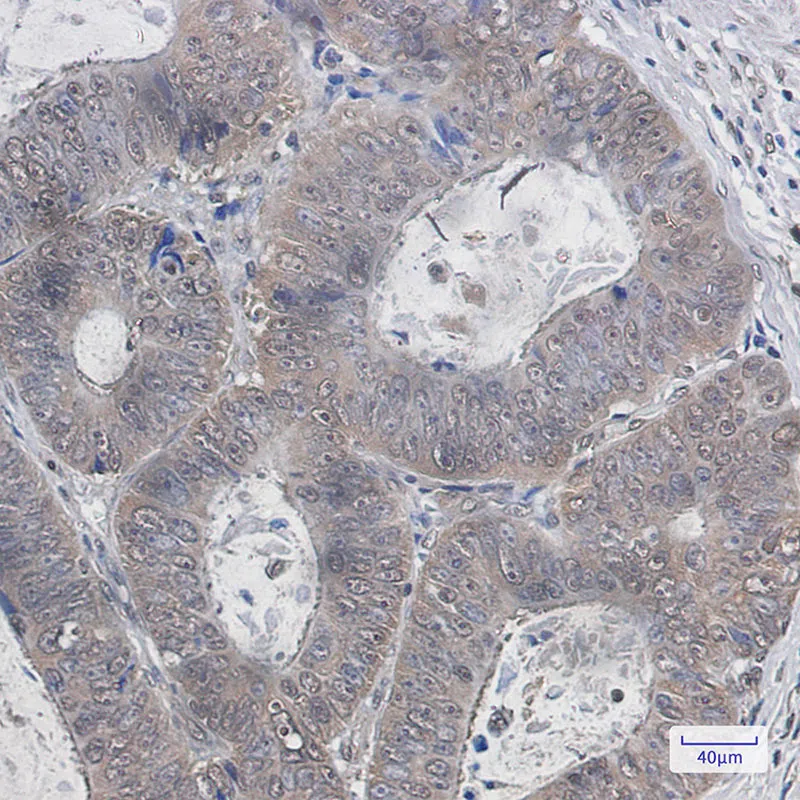 Immunohistochemistry analysis of paraffin-embedded Human colon cancer using K48 Linkage Specific Ubiquitin antibody. High-pressure and temperature Sodium Citrate pH 6.0 was used for antigen retrieval.