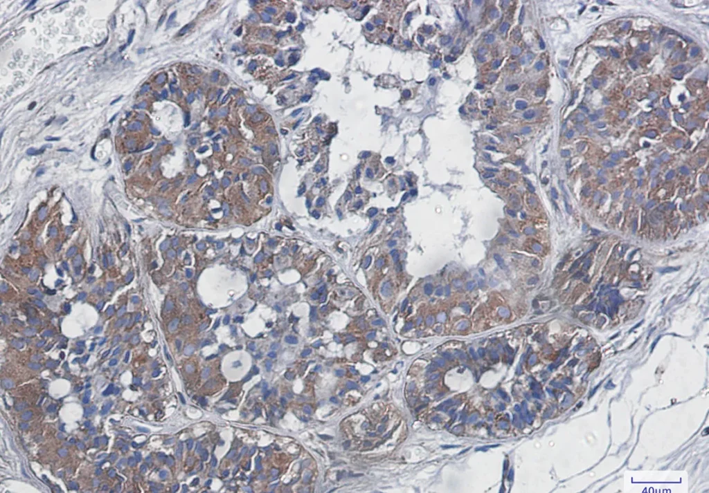 Immunohistochemistry analysis of paraffin-embedded Human breast cancer using NF-KB p65 antibody. High-pressure and temperature Sodium Citrate pH 6.0 was used for antigen retrieval.