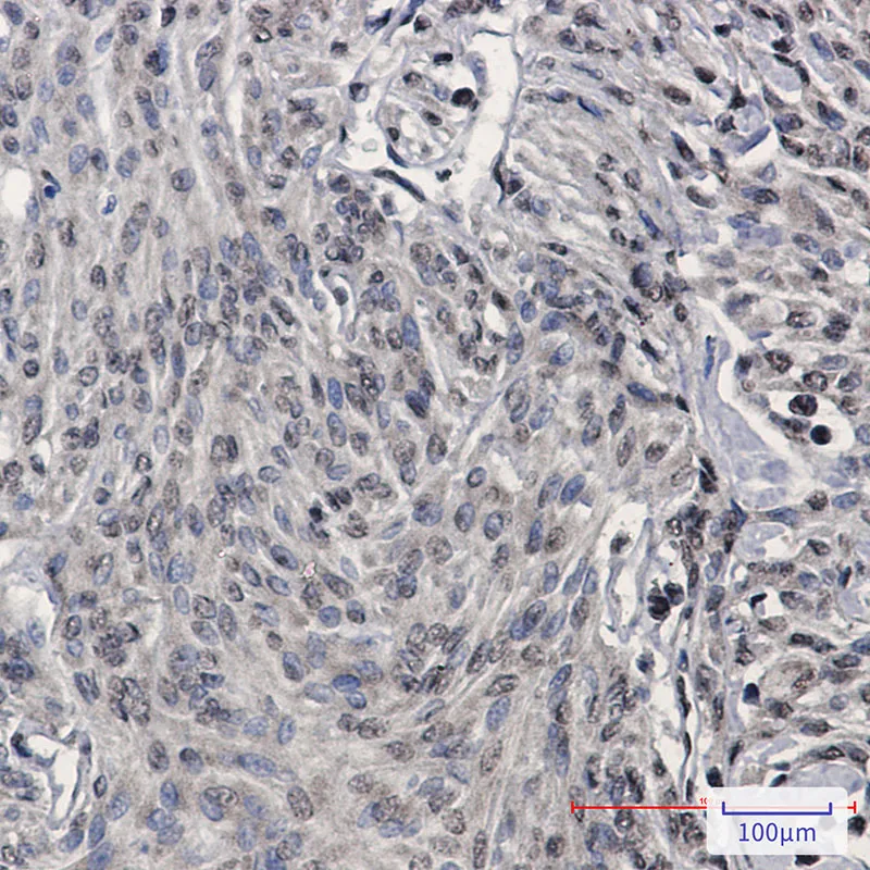 Immunohistochemistry analysis of paraffin-embedded Human brain using TDP 43 antibody.High-pressure and temperature Sodium Citrate pH 6.0 was used for antigen retrieval.