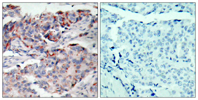 Immunohistochemistry analysis of paraffin-embedded human breast carcinoma, using JAK2 (Phospho-Tyr221) Antibody. The picture on the right is blocked with the phospho peptide.