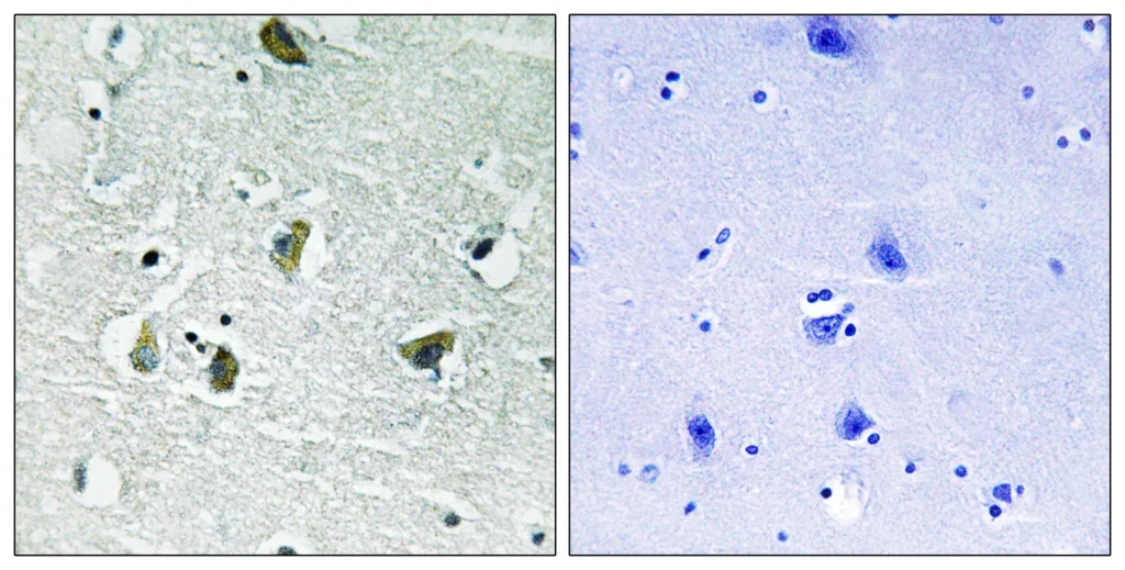 Immunohistochemistry analysis of paraffin-embedded human brain, using JAK2 （Phospho-Tyr931） Antibody. The picture on the right is blocked with the phospho peptide.