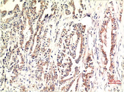 Immunohistochemistry analysis of paraffin-embedded Human Stomach Carcinoma Tissue using CHOP antibody. High-pressure and temperature Sodium Citrate pH 6.0 was used for antigen retrieval.