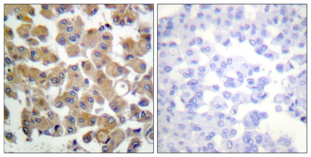 Immunohistochemistry analysis of paraffin-embedded human breast carcinoma tissue, using TGF beta1 Antibody. The picture on the right is blocked with the synthesized peptide.
