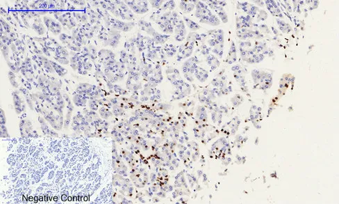 Immunohistochemical analysis of paraffin-embedded Human-stomach-cancer tissue. 1,Histone H2A.X （phospho Ser139） Polyclonal Antibody was diluted at 1:200 （ 4°C,overnight ） . 2, Sodium citrate pH 6.0 was used for antibody retrieval（>98°C,20min）. 3,Secondary antibody was diluted at 1:200（room tempeRature, 30min）. Negative control was used by secondary antibody only.