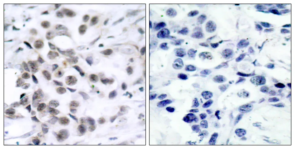 Immunohistochemistry analysis of paraffin-embedded human breast carcinoma tissue, using Chk1 Antibody. The picture on the right is blocked with the synthesized peptide.