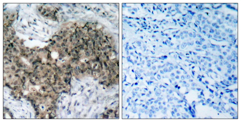 Immunohistochemistry analysis of paraffin-embedded human breast carcinoma tissue, using ATM Antibody. The picture on the right is blocked with the synthesized peptide.
