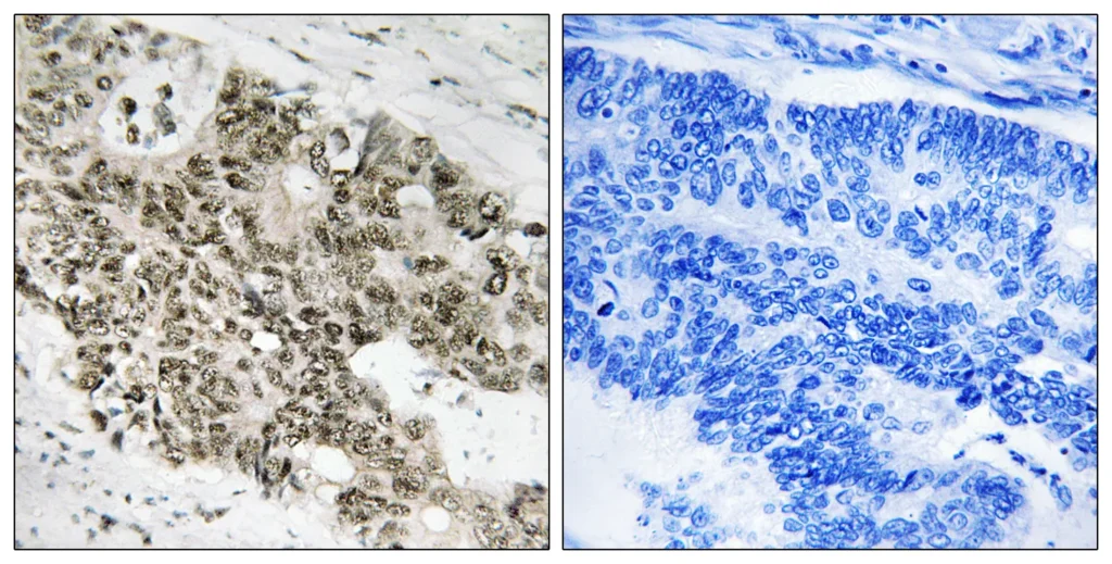 Immunohistochemistry analysis of paraffin-embedded human colon carcinoma, using ATR Antibody. The picture on the right is blocked with the synthesized peptide.