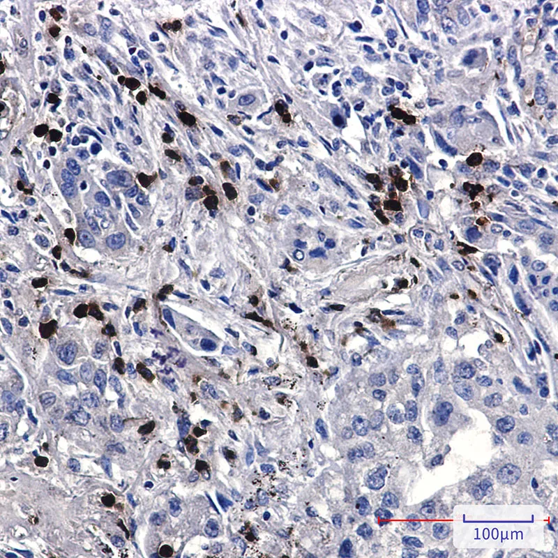 Immunohistochemistry analysis of paraffin-embedded Human lung cancer tissue using FE65 antibody. High-pressure and temperature Sodium Citrate pH 6.0 was used for antigen retrieval.