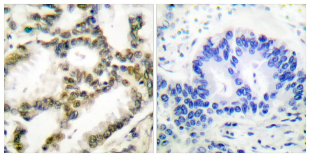 Immunohistochemistry analysis of paraffin-embedded human lung carcinoma tissue, using DJ-1 Antibody. The picture on the right is blocked with the synthesized peptide.