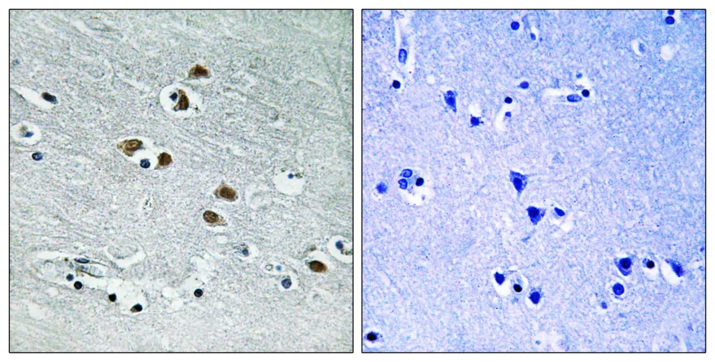 Immunohistochemistry analysis of paraffin-embedded human brain tissue, using HDAC6 Antibody. The picture on the right is blocked with the synthesized peptide.