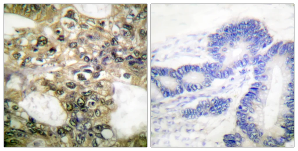 Immunohistochemistry analysis of paraffin-embedded human colon carcinoma tissue, using HDAC6 Antibody. The picture on the right is blocked with the synthesized peptide.