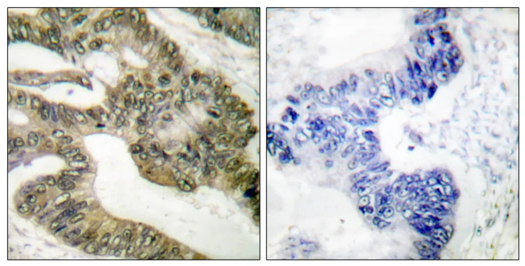 Immunohistochemistry analysis of paraffin-embedded human colon carcinoma tissue, using APC Antibody. The picture on the right is blocked with the synthesized peptide.