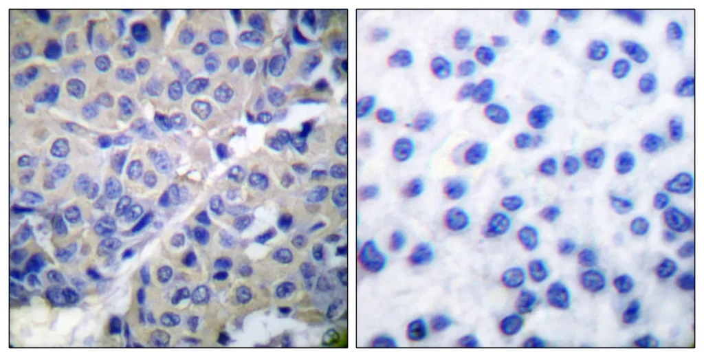 Immunohistochemistry analysis of paraffin-embedded human breast carcinoma, using Synaptotagmin （Phospho-Ser309） Antibody. The picture on the right is blocked with the phospho peptide.