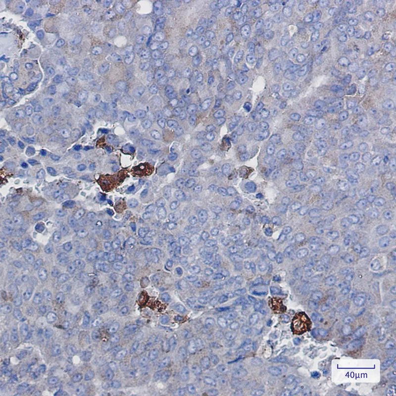Immunohistochemistry analysis of paraffin-embedded Human breast cancer using Amyloid Precursor Protein antibody. High-pressure and temperature Sodium Citrate pH 6.0 was used for antigen retrieval.