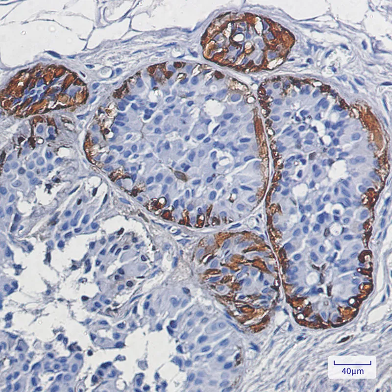 Immunohistochemistry analysis of paraffin-embedded Human breast cancer using S100 beta antibody. High-pressure and temperature Sodium Citrate pH 6.0 was used for antigen retrieval.