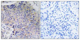 Immunohistochemistry analysis of paraffin-embedded Human lung cancer using Tau antibody. High-pressure and temperature Tris-EDTA pH 8.0 was used for antigen retrieval. Sample with blocking peptide on the right.