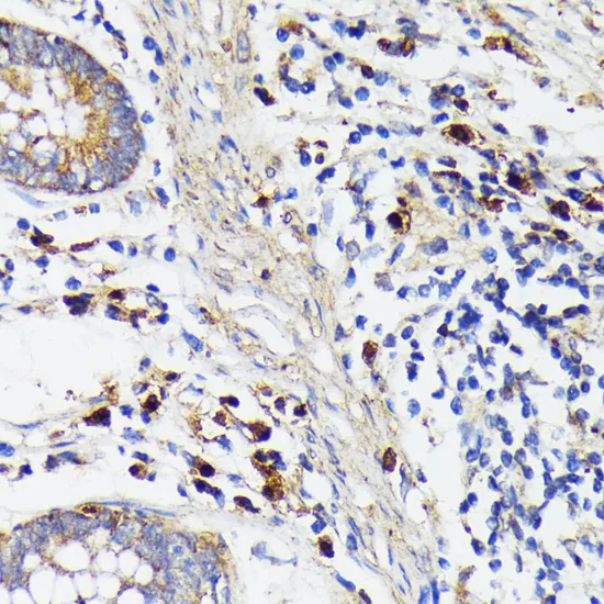 Immunohistochemistry analysis of paraffin-embedded Human colon carcinoma using TREM2 antibody. High-pressure and temperature Sodium Citrate pH 6.0 was used for antigen retrieval.