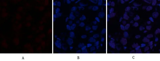 Immunofluorescence analysis of human-breast-cancer tissue. 1,ABCG2 Polyclonal Antibody（red） was diluted at 1:200（4°C,overnight）. 2, Cy3 labled Secondary antibody was diluted at 1:300（room temperature, 50min）.3, Picture B: DAPI（blue） 10min. Picture A:Target. Picture B: DAPI. Picture C: merge of A+B
