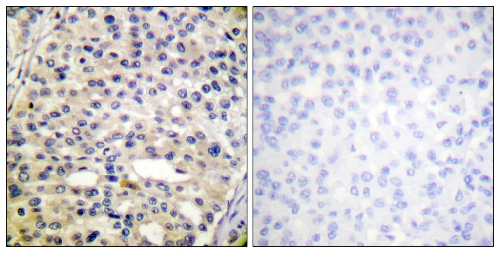 Immunohistochemistry analysis of paraffin-embedded human breast carcinoma, using Vimentin (Phospho-Ser56) Antibody. The picture on the right is blocked with the phospho peptide.