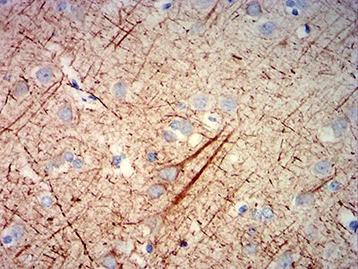 Immunohistochemical analysis of paraffin-embedded human cerebrum tissues using NEFH mouse mAb with DAB staining.