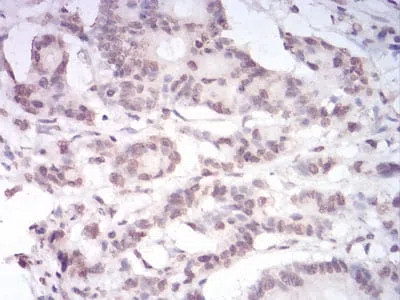 Immunohistochemical analysis of paraffin-embedded human colon cancer tissues using PAX6 mouse mAb with DAB staining.