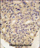 Formalin-fixed and paraffin-embedded human hepatocarcinoma tissue reacted with PINK1 Monoclonal Antibody (Cat.#AMM85907), which was peroxidase-conjugated to the secondary antibody, followed by DAB staining. This data demonstrates the use of this antibody for immunohistochemistry; clinical relevance has not been evaluated.