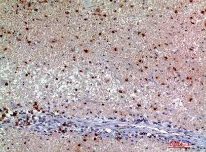 Immunohistochemical analysis of paraffin-embedded human-kidneycancer, antibody was diluted at 1:200