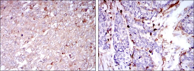 Immunohistochemical analysis of paraffin-embedded human breast cancer tissues (left) and human esophageal cancer tissues (right) using CD133 mouse mAb with DAB staining.