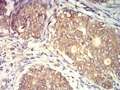 Immunohistochemical analysis of paraffin-embedded human cervical cancer tissues using CD140a mouse mAb with DAB staining.