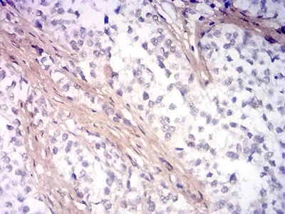 Immunohistochemical analysis of paraffin-embedded human bladder cancer tissues using PINK1 mouse mAb with DAB staining.