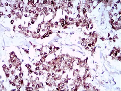 Immunohistochemical analysis of paraffin-embedded human breast cancer tissues using SOX10 mouse mAb with DAB staining.