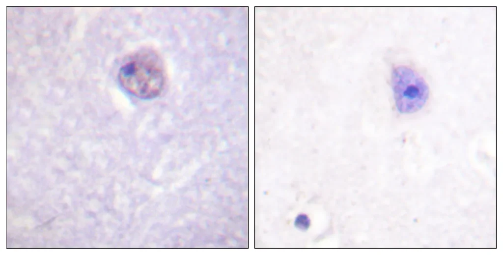 Immunohistochemistry analysis of paraffin-embedded human brain, using SOX-9 (Phospho-Ser181) Antibody. The picture on the right is blocked with the phospho peptide.
