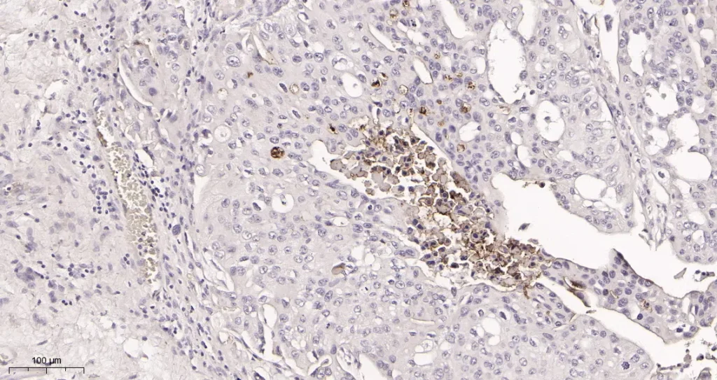 Immunohistochemical analysis of paraffin-embedded human bladder carcinoma tissue. 1, CD133 Rabbit Monoclonal Antibody was diluted at 1:200(4°C,overnight). 2, EDTA pH 9.0 was used for antibody retrieval(>98°C,20min). 3,Secondary antibody was diluted at 1:200(room temperature, 30min).