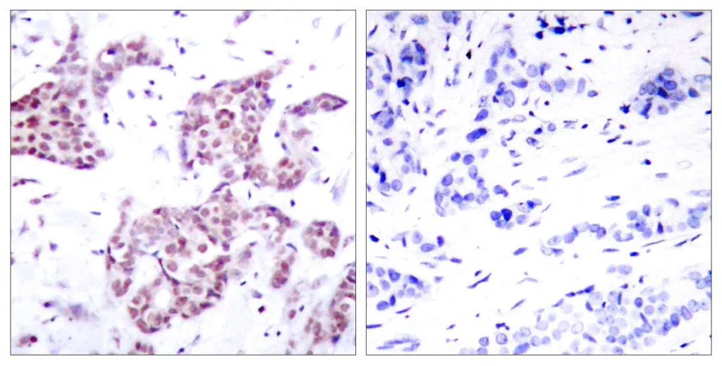 Immunohistochemistry analysis of paraffin-embedded human breast carcinoma, using STAT6 (Phospho-Tyr641) Antibody. The picture on the right is blocked with the phospho peptide.
