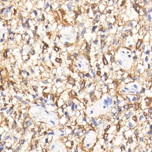 IHC analysis of GFAP.Sample: Human glioblastoma multiforme, 4% PFA 12-24h.Antigen retrieval: Citrate buffer , pressure cooker 2 min.Primary antibody: 1: 500, 4℃ overnight.Secondary antibody: HRP conjugated Goat Anti-Mouse lgG , 1: 200, RT, 1h.
