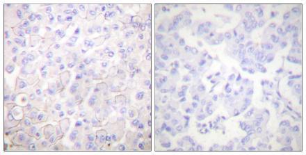 Immunohistochemistry analysis of paraffin-embedded human breast carcinoma tissue, using E-Cadherin Antibody. The picture on the right is Blocked with the synthesized peptide.