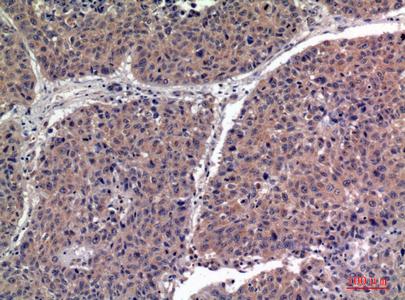 Immunohistochemical analysis of paraffin-embedded human-lung, antibody wasdilutedat1:100