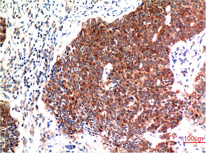 Immunohistochemical analysis of paraffin-embedded Human Breast Carcinoma Tissue using Beclin-1 Mouse mAb diluted at 1:200.