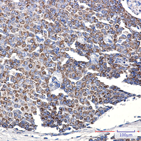 Immunohistochemistry analysis of paraffin-embedded Human breast cancer using TOMM20 antibody.High-pressure and temperature Sodium Citrate pH 6.0 was used for antigen retrieval.