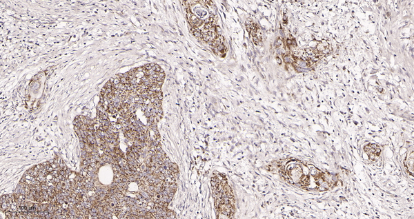 Immunohistochemical analysis of paraffin-embedded human cervical carcinoma tissue. 1, TOMM20 Rabbit Monoclonal Antibody was diluted at 1:200(4°C,overnight). 2, EDTA pH 9.0 was used for antibody retrieval(>98°C,20min). 3,Secondary antibody was diluted at 1:200(room temperature, 30min).
