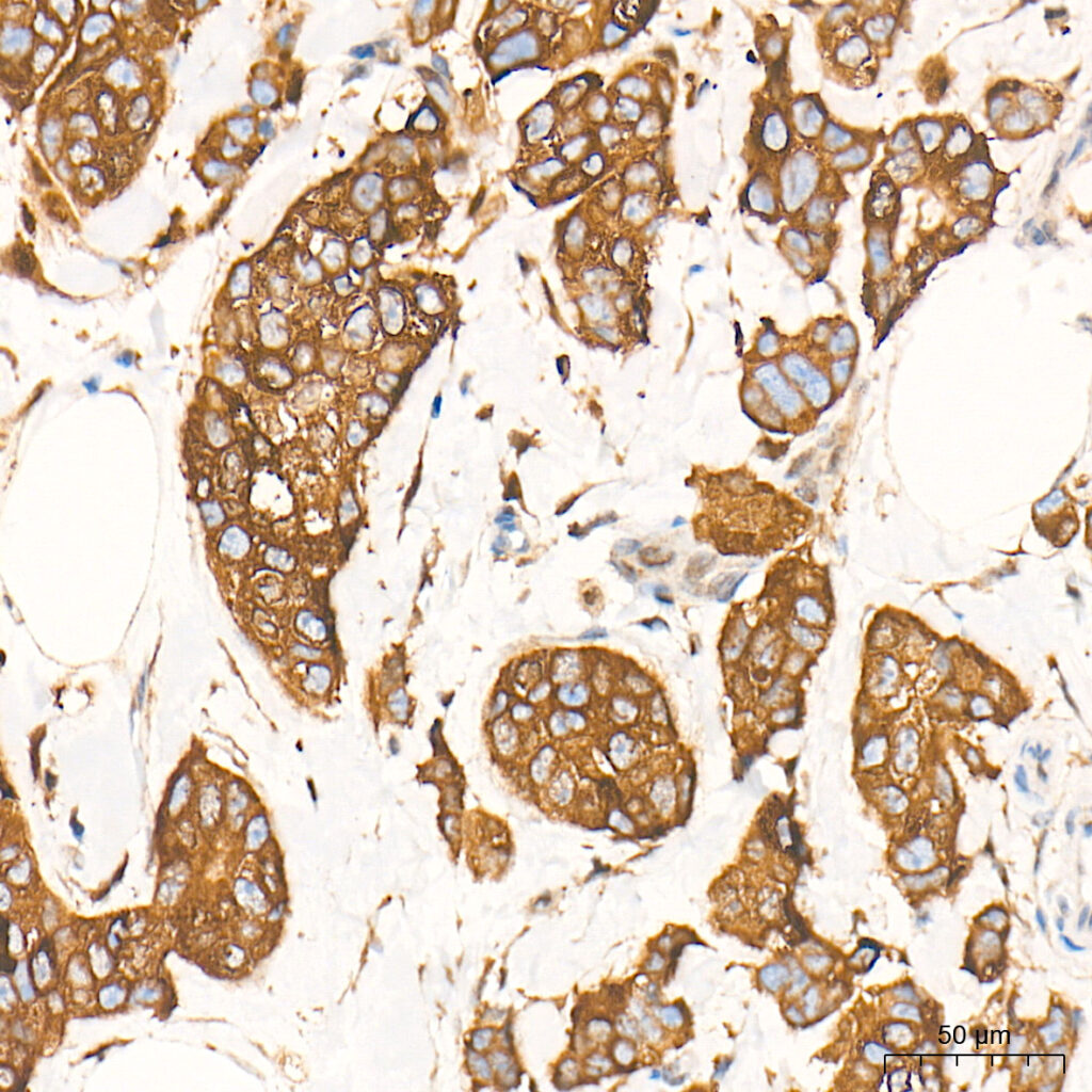 Immunohistochemistry analysis of paraffin-embedded Human breast cancer tissue using [KO Validated] SQSTM1/p62 Rabbit mAb at a dilution of 1:5000 (40x lens).