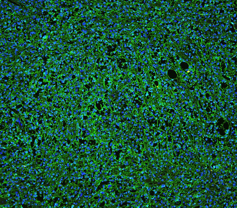CD20/MS4A1 was detected in a paraffin-embedded section of human B lymphocytic tumor tissue. The tissue section was incubated with rabbit anti-CD20/MS4A1 Antibody at a dilution of 1:100. Fluoro594-conjugated Anti-rabbit IgG Secondary Antibody (red) was used as secondary antibody. The section was counterstained with DAPI (Blue).