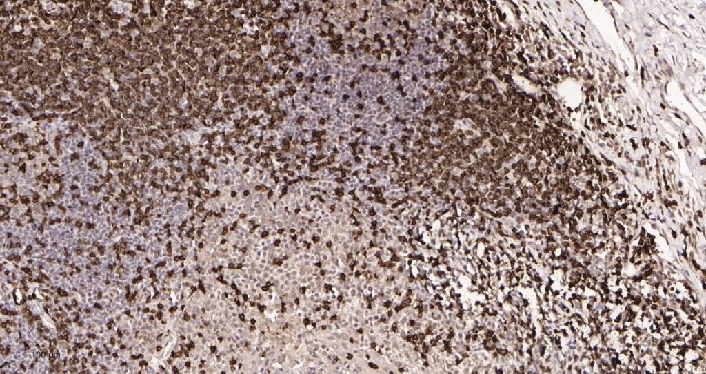 Immunohistochemical analysis of paraffin-embedded Human tonsil tissue. 1, CD3 Rabbit Monoclonal Antibody was diluted at 1:200(4°C,overnight). 2, EDTA pH 9.0 was used for antibody retrieval(>98°C,20min). 3,Secondary antibody was diluted at 1:200(room temperature,30min).